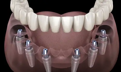 dental implant all on 4 turkey