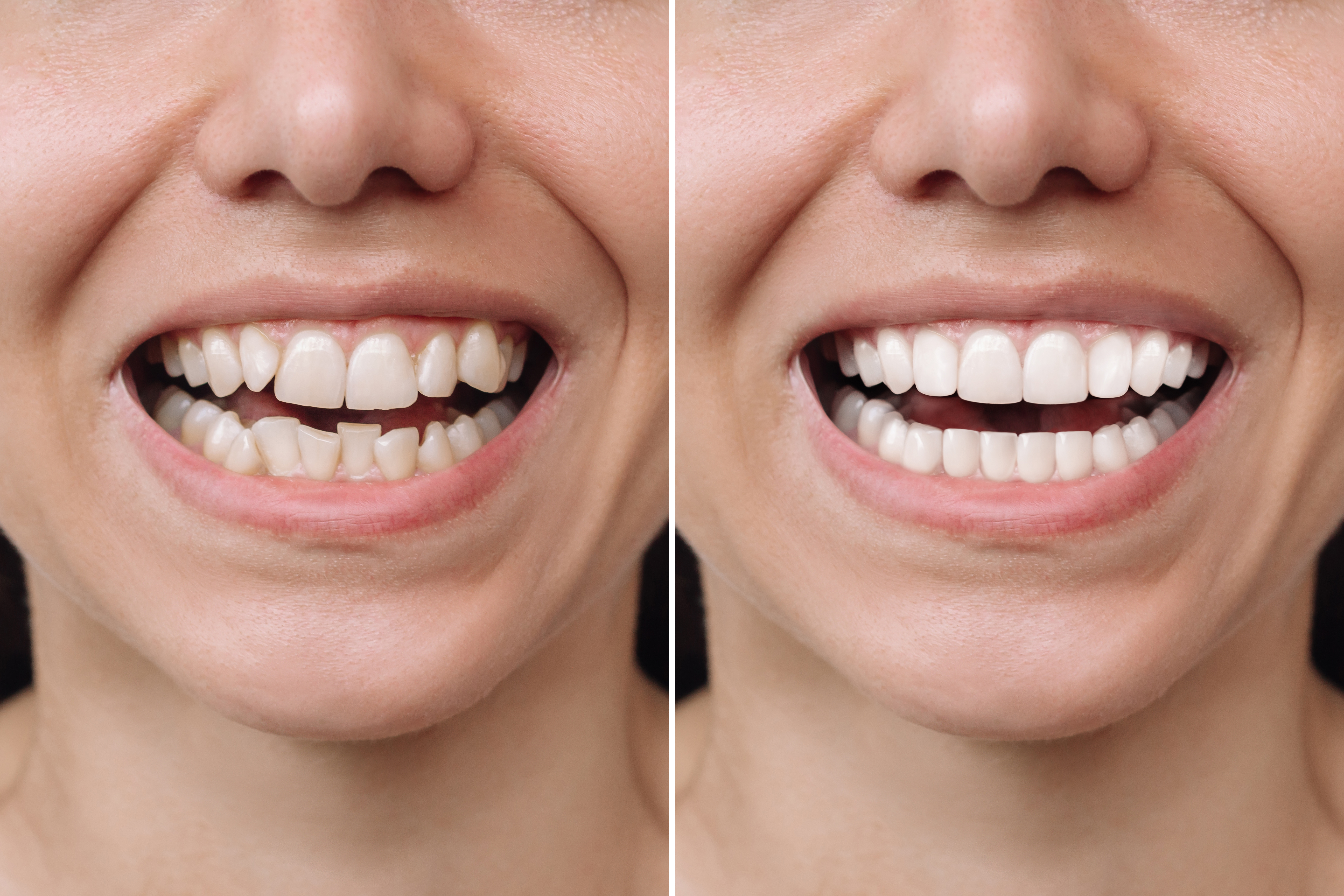 Turkey teeth before and after-3 Turkey teeth before and after-3