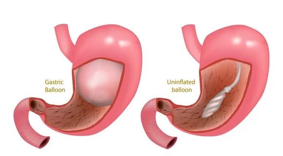 gastric-balloon-vs-gastric-sleeve-turkey