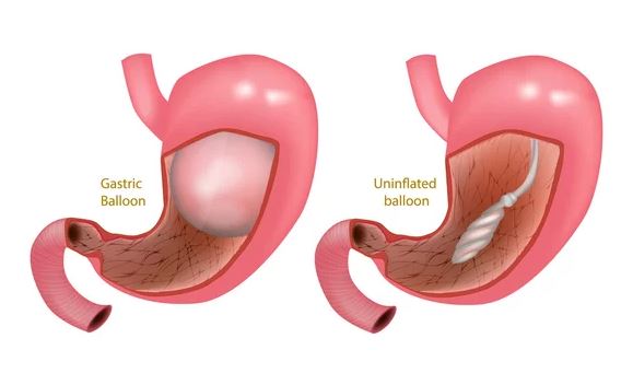 Gastric balloon or gastric sleeve? Which one to choose?