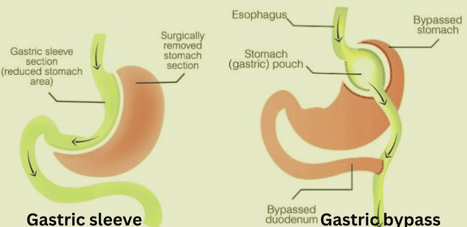 astric-bypass-vs-gastric-sleeve-turkey