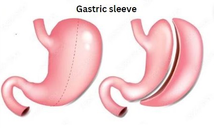 Gastric sleeve or gastric ballons?