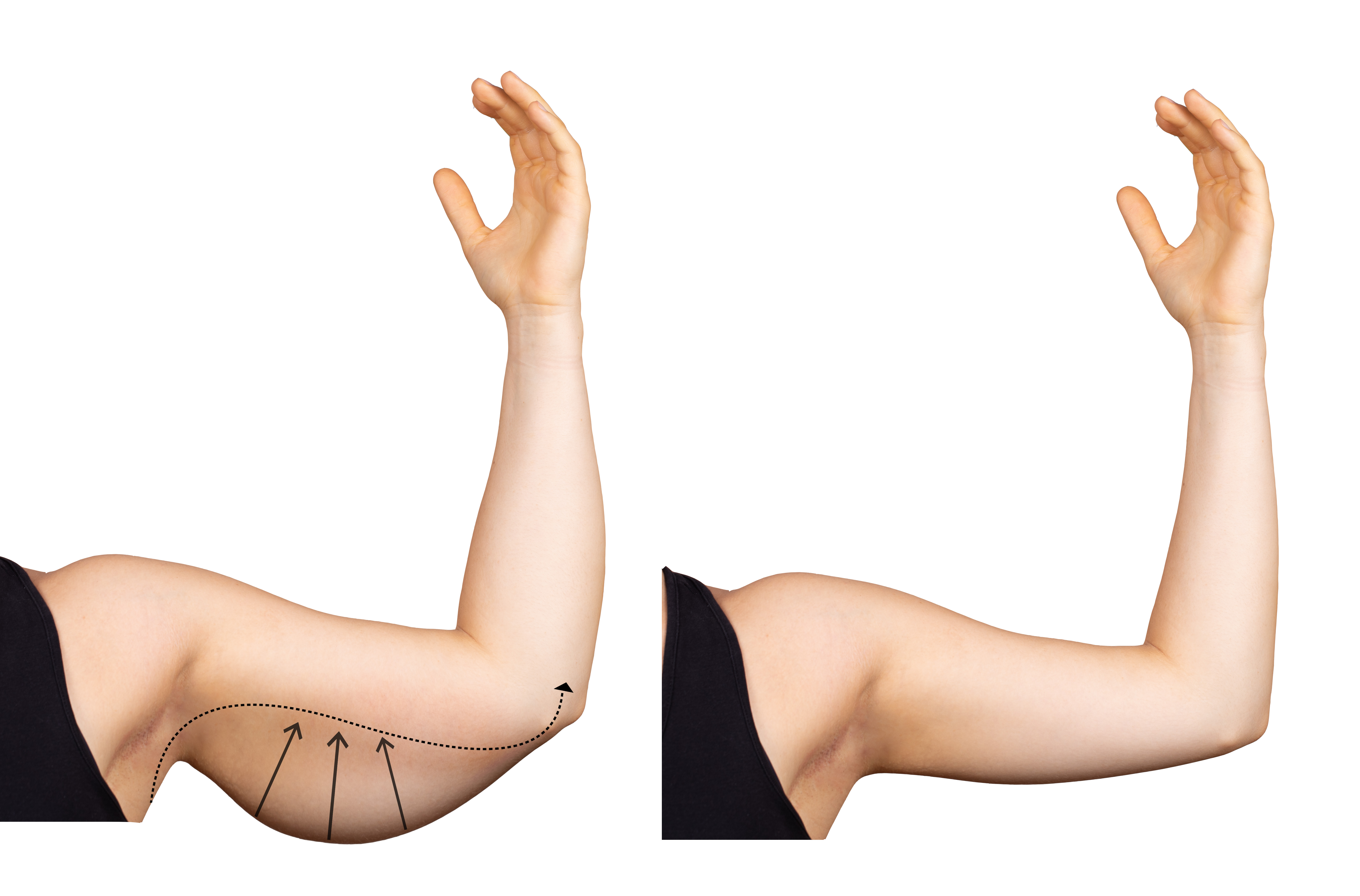 arm lift before and after-1 