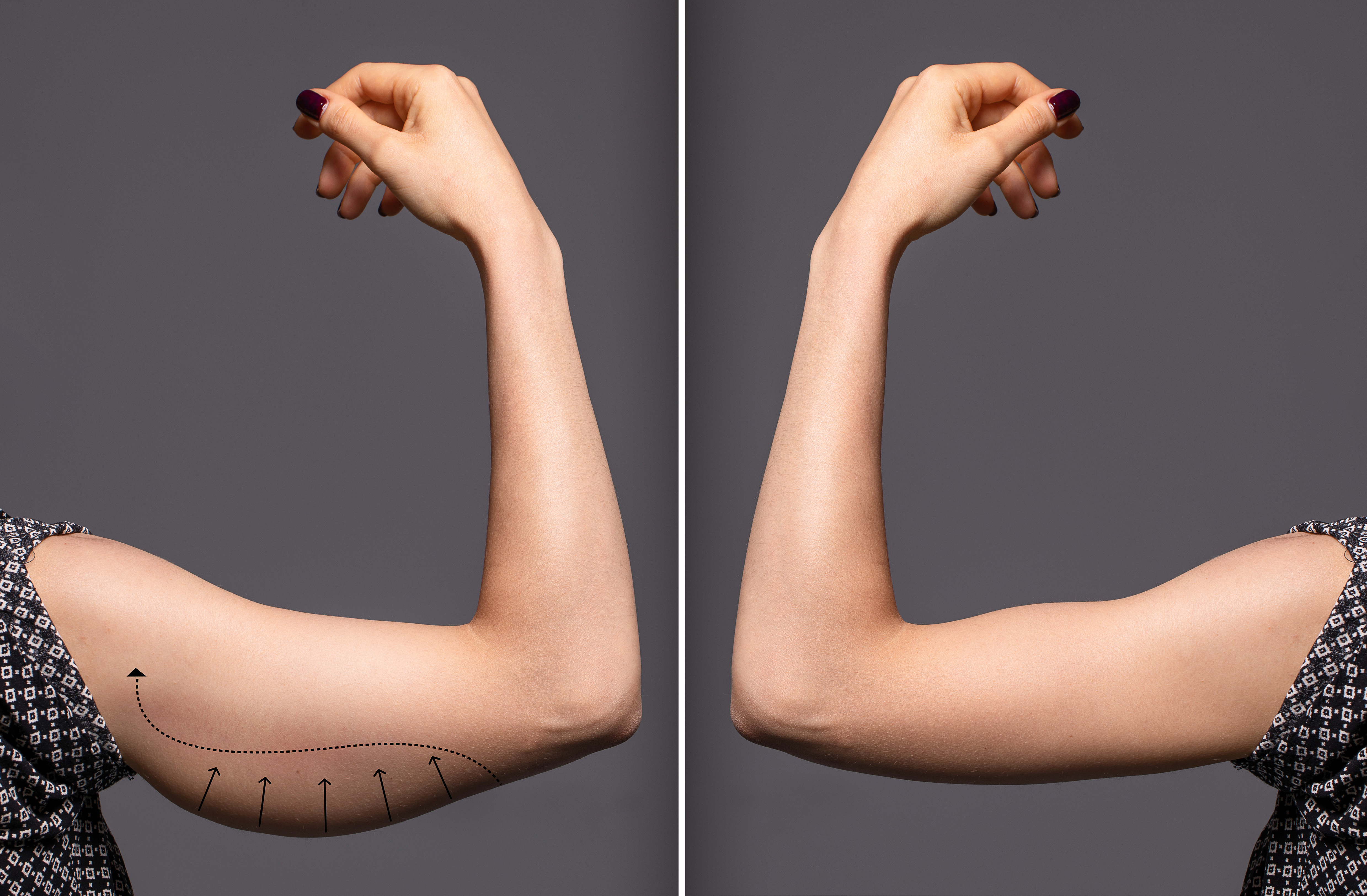arm lift before and after-4 