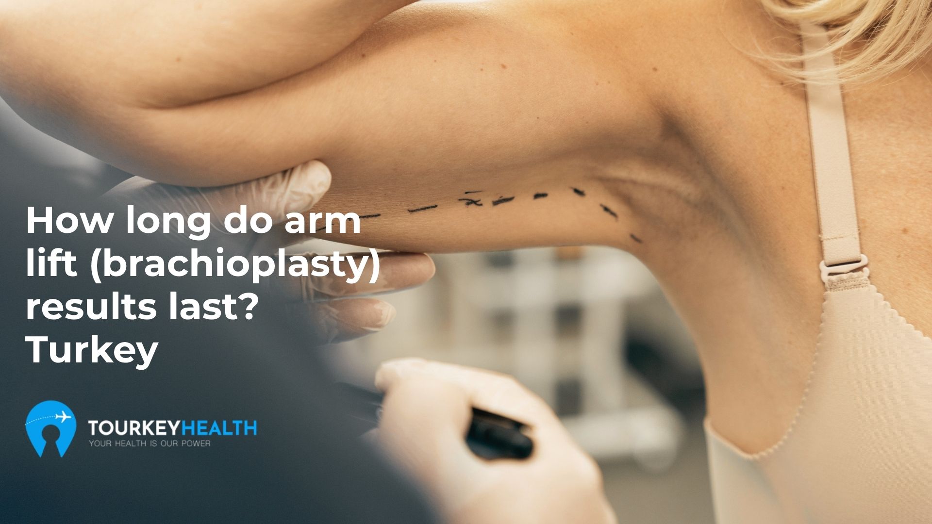 How long do arm lift results last? 