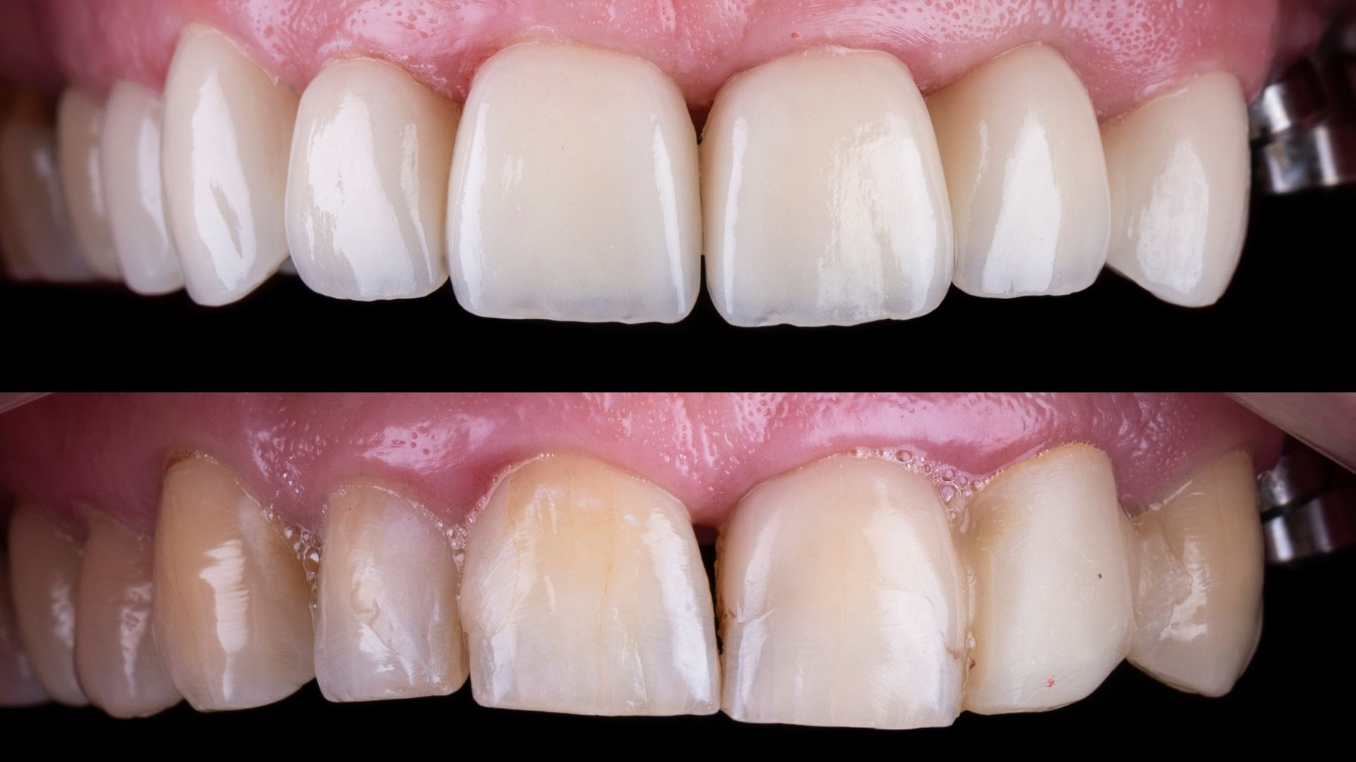 turkey-veneers-before-after-2 turkey-veneers-before-after-2