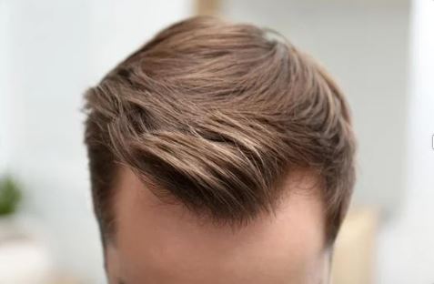 Does the transplanted hair fall out?