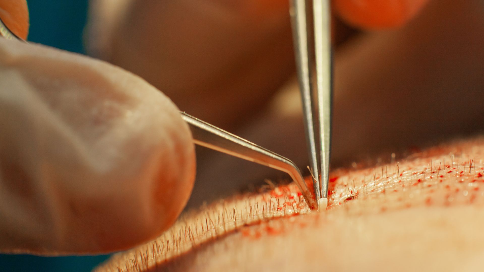 hair transplantation in Turkey